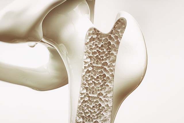 骨粗鬆症